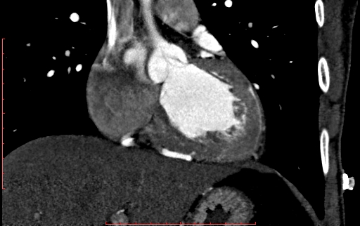 Anomalous left coronary artery from the pulmonary artery (ALCAPA) (Radiopaedia 70148-80181 B 146).jpg