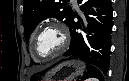 File:Anomalous left coronary artery from the pulmonary artery (ALCAPA) (Radiopaedia 70148-80181 C 199).jpg