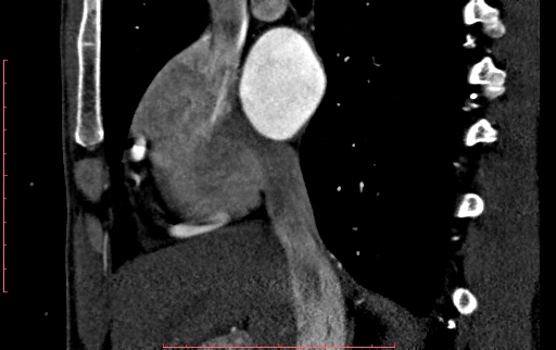 Anomalous left coronary artery from the pulmonary artery (ALCAPA) (Radiopaedia 70148-80181 C 49).jpg