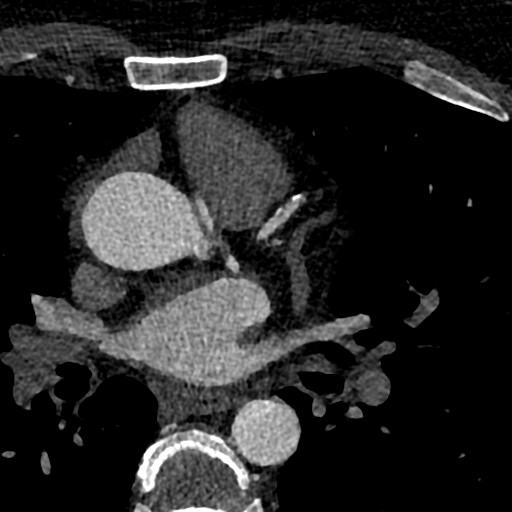 File:Anomalous origin of the left coronary artery with malignant course (Radiopaedia 77842-90126 C 27).jpeg