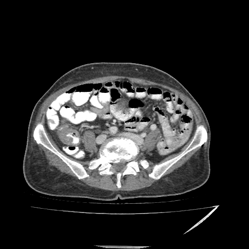 Anorectal carcinoma (Radiopaedia 44413-48064 A 37).jpg