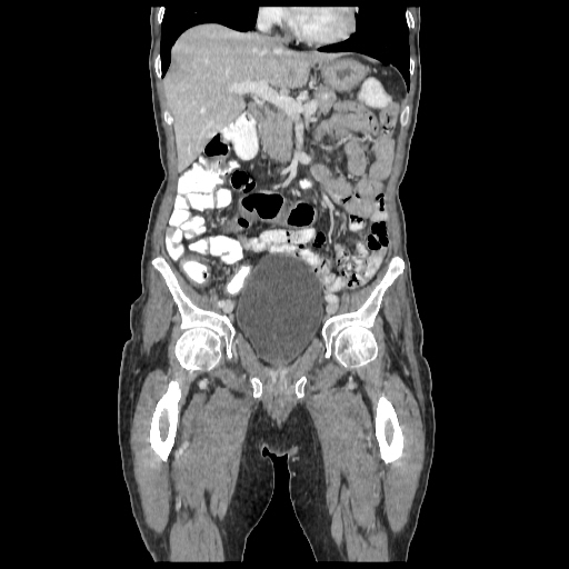 Anorectal carcinoma (Radiopaedia 44413-48064 B 28).jpg