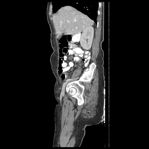 Anorectal carcinoma (Radiopaedia 44413-48064 C 25).jpg