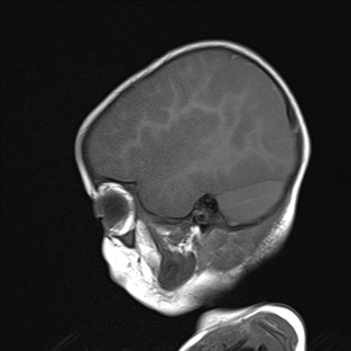 File:Anoxic brain injury (Radiopaedia 79165-92139 Sagittal T1 6).jpg