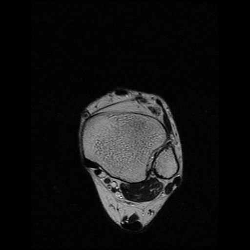 File:Anterior calcaneal process fracture (Radiopaedia 74654-85611 Axial T2 3).jpg