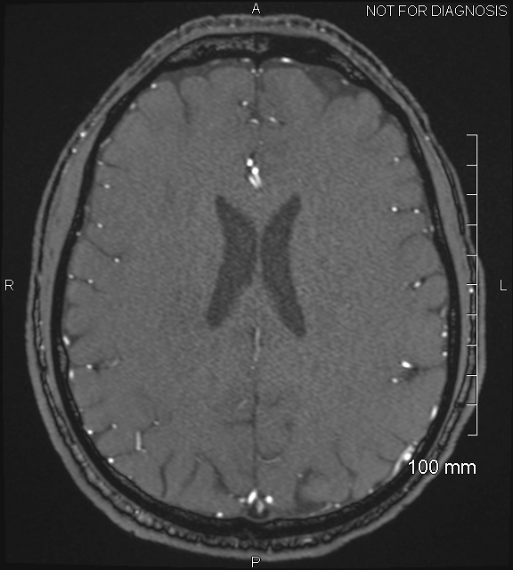 Anterior cerebral artery aneurysm (Radiopaedia 80683-94127 Axial MRA 162).jpg