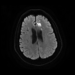 Anterior cerebral artery infarction (Radiopaedia 46794-51323 Axial DWI 19).jpg