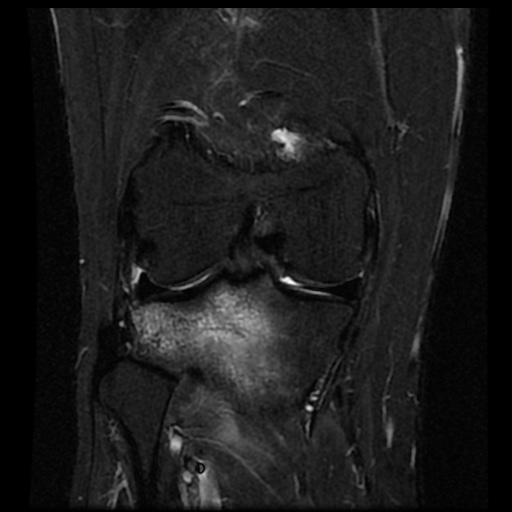 File:Anterior cruciate ligament avulsion fracture (Radiopaedia 58939-66193 Coronal STIR 12).jpg