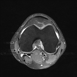 File:Anterior cruciate ligament full thickness tear (Radiopaedia 66268-75467 Axial PD fat sat 14).jpg