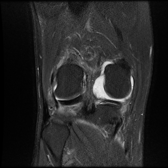 File:Anterior cruciate ligament graft tear and bucket-handle tear of medial meniscus (Radiopaedia 75867-87255 Coronal PD fat sat 19).jpg