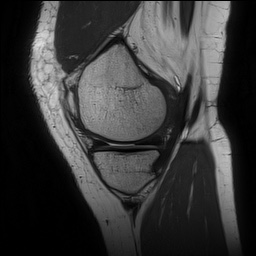 Anterior cruciate ligament rupture and posteromedial corner injury (Radiopaedia 67338-76723 Sagittal PD 47).jpg