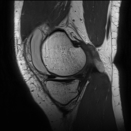 Anterior cruciate ligament rupture with Segond fracture (Radiopaedia 69043-78806 Sagittal PD 53).jpg