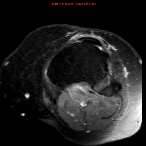 File:Anterior cruciate ligament tear (Radiopaedia 12329-12612 Axial T2 fat sat 4).jpg