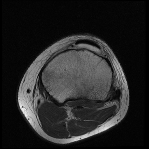 File:Anterior cruciate ligament tear (Radiopaedia 61500-69462 Axial PD 18).jpg