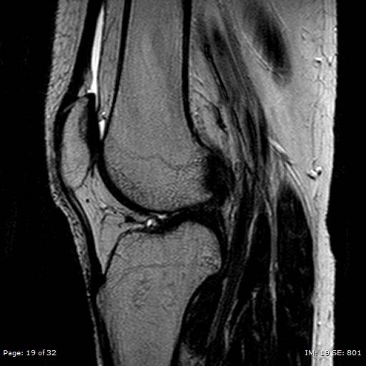 File:Anterior cruciate ligament tear (Radiopaedia 70783-80964 Sagittal T2 19).jpg