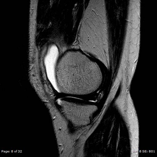 File:Anterior cruciate ligament tear (Radiopaedia 70783-80964 Sagittal T2 8).jpg