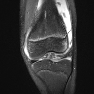 File:Anterior cruciate ligament tear - pediatric (Radiopaedia 62152-70260 Coronal PD fat sat 18).jpg