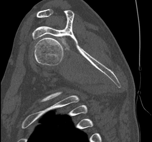 Anterior glenohumeral dislocation with Hill-Sachs lesion (Radiopaedia 62877-71249 Sagittal bone window 37).jpg