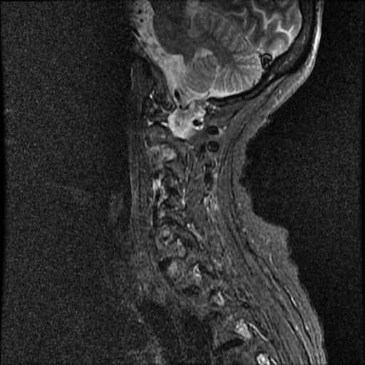 File:Anterior spinal artery syndrome (Radiopaedia 46335-50750 Sagittal STIR 3).png