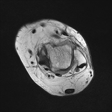 File:Anterior talofibular ligament injury - rupture with soft-tissue impingement (Radiopaedia 38765-40928 Axial PD 17).jpg