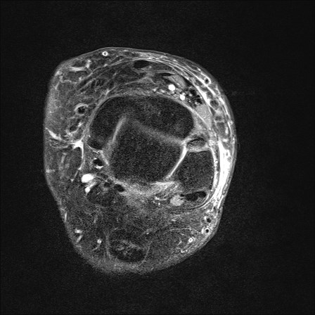 File:Anterior talofibular ligament injury - rupture with soft-tissue impingement (Radiopaedia 38765-40928 D 15).jpg