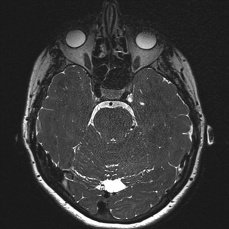 Anterior temporal encephalocele (Radiopaedia 82624-96808 Axial T2 high res 59).jpg