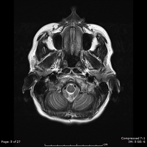 File:Anterior temporal lobe perivascular space (Radiopaedia 88283-104914 Axial T2 5).jpg