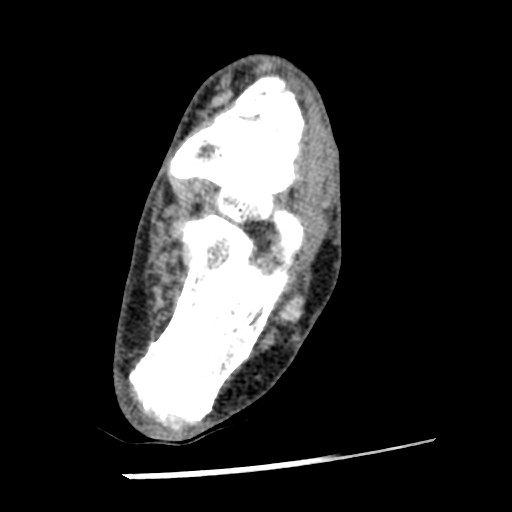 Anterior tibial artery false aneurysm (Radiopaedia 88984-105809 A 173).jpg