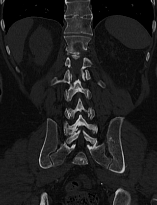 File:Anterior vertebral scalloping (abdominal aortic aneurysm) (Radiopaedia 66744-76067 Coronal bone window 53).jpg