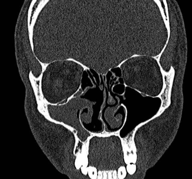Antrochoanal polyp (Radiopaedia 30002-30554 Coronal bone window 33).jpg