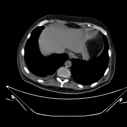 Aortic arch aneurysm (Radiopaedia 84109-99365 Axial non-contrast 237).jpg