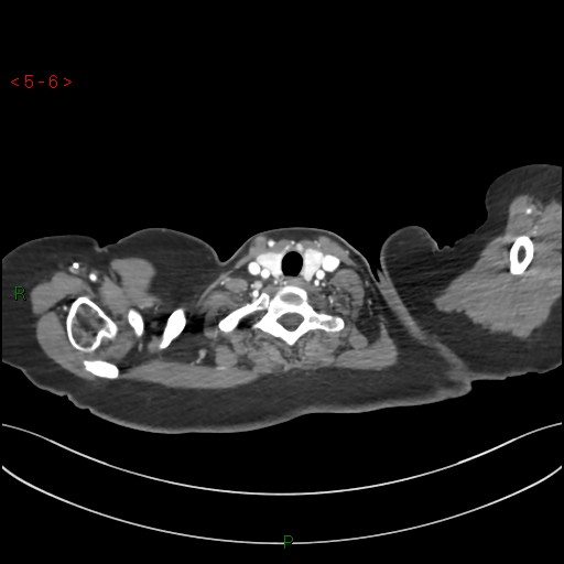 Aortic arch origin of left vertebral artery (Radiopaedia 51520-57286 A 5).jpg