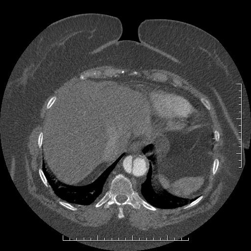 File:Aortic dissection- Stanford A (Radiopaedia 35729-37268 B 18).jpg