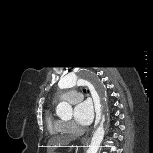 File:Aortic dissection- Stanford A (Radiopaedia 35729-37268 D 20).jpg