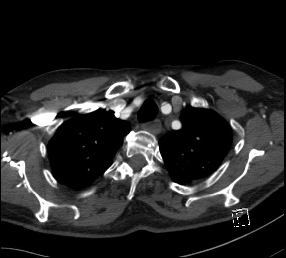 Aortic dissection (CTPA) (Radiopaedia 75506-86750 A 16).jpg
