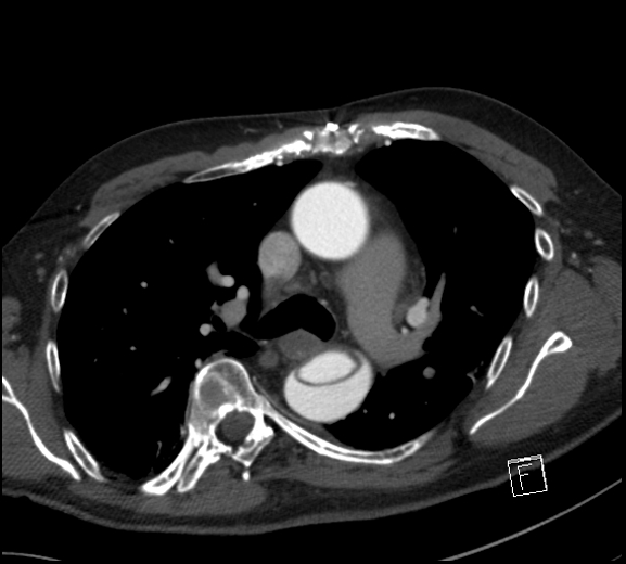 File:Aortic dissection (CTPA) (Radiopaedia 75506-86750 A 38).jpg