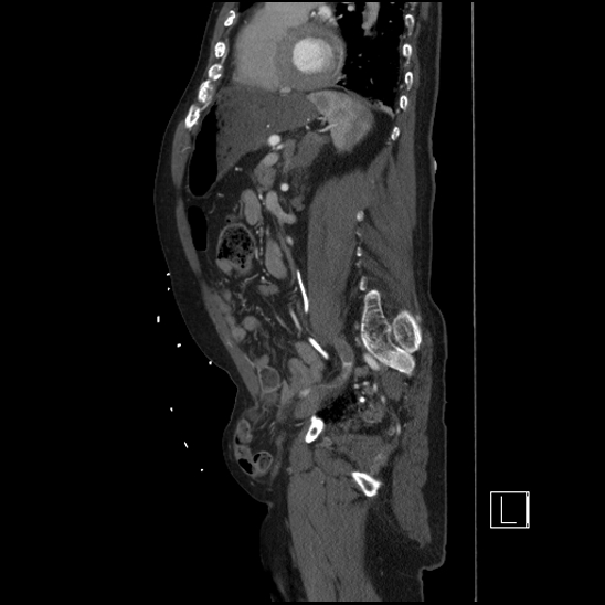 Aortic dissection (CTPA) (Radiopaedia 75506-86750 G 72).jpg