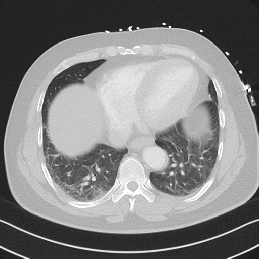 File:Aortic dissection (Radiopaedia 50763-56234 Axial lung window 47).png