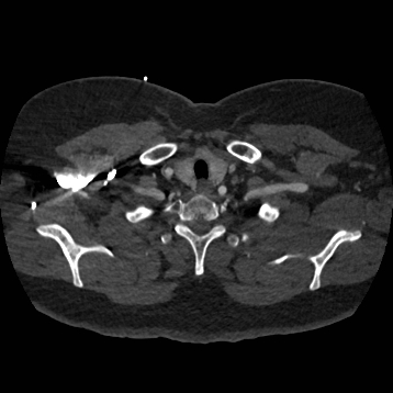 File:Aortic dissection (Radiopaedia 57969-64959 A 33).jpg