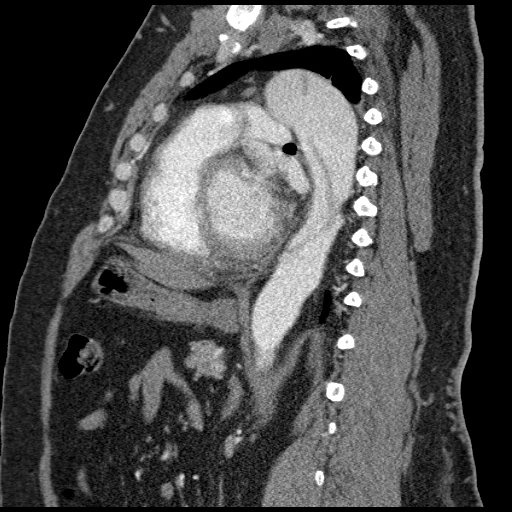 File:Aortic dissection (Radiopaedia 7687-8505 B 1).jpg