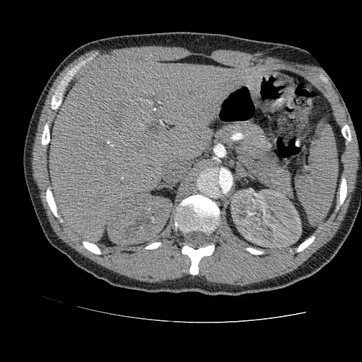 File:Aortic dissection - Stanford A -DeBakey I (Radiopaedia 28339-28587 B 110).jpg