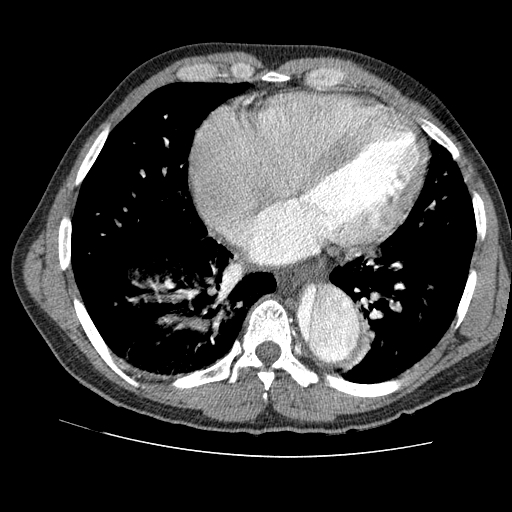 File:Aortic dissection - Stanford A -DeBakey I (Radiopaedia 28339-28587 B 67).jpg