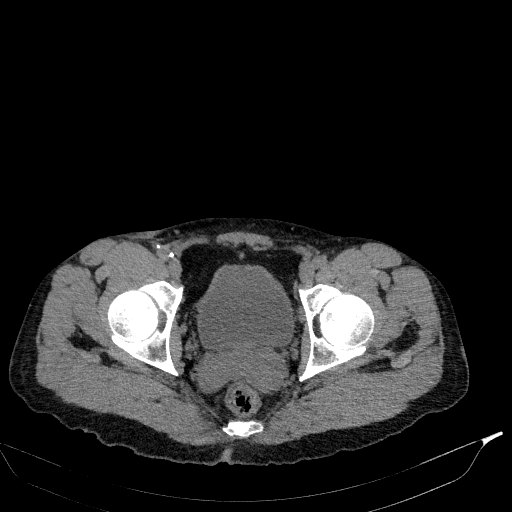 Aortic dissection - Stanford type A (Radiopaedia 83418-98500 Axial non-contrast 88).jpg