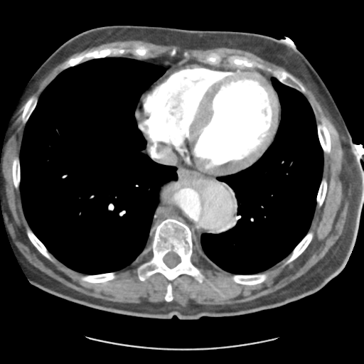 Aortic dissection - Stanford type B (Radiopaedia 50171-55512 A 36).png