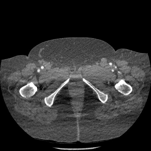 File:Aortic dissection - Stanford type B (Radiopaedia 88281-104910 A 167).jpg