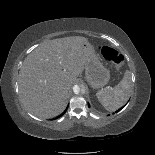 Aortic dissection - Stanford type B (Radiopaedia 88281-104910 A 91).jpg
