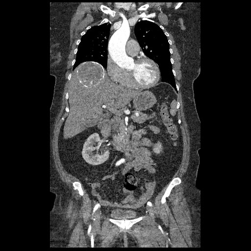 File:Aortic dissection - Stanford type B (Radiopaedia 88281-104910 B 22).jpg