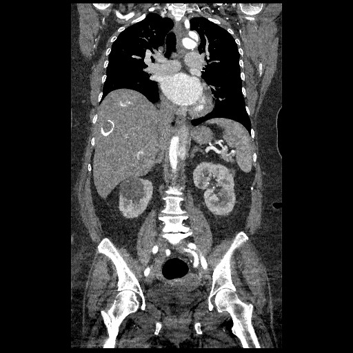 File:Aortic dissection - Stanford type B (Radiopaedia 88281-104910 B 42).jpg