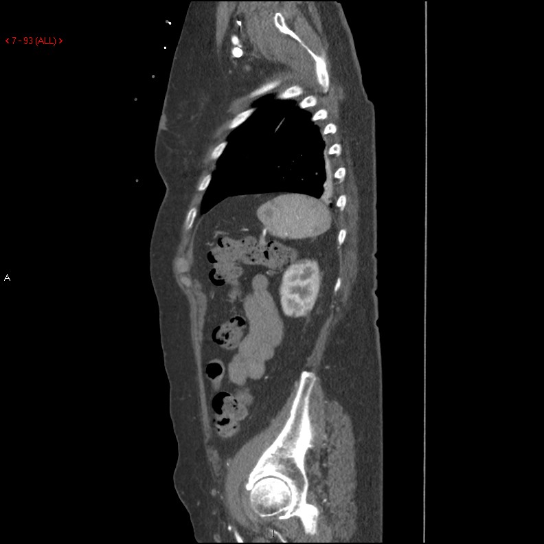 Aortic intramural hematoma (Radiopaedia 27746-28001 C 62).jpg