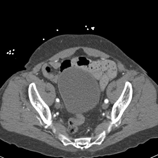 File:Aortic intramural hematoma (Radiopaedia 31139-31838 B 148).jpg